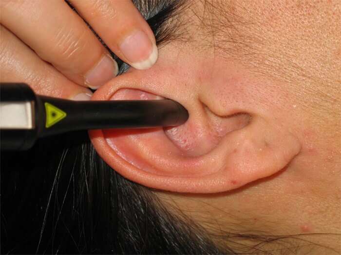 akupunktur kulak lazer tedavi 1