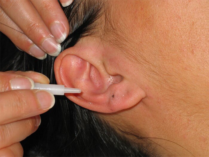 akupunktur kulak lazer tedavi
