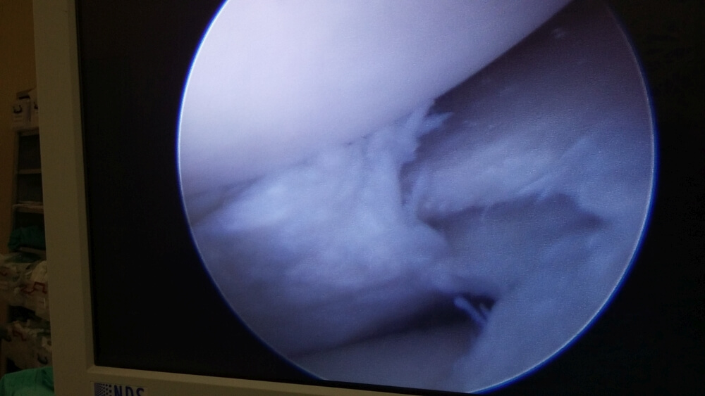 dis lateral meniskus yirtigi 1