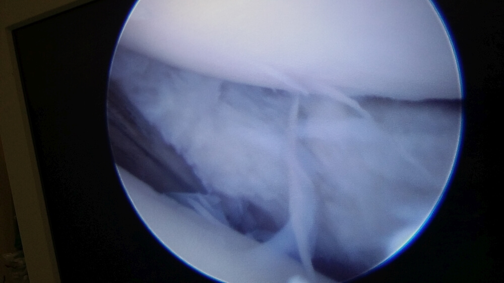 dis lateral meniskus yirtigi 5