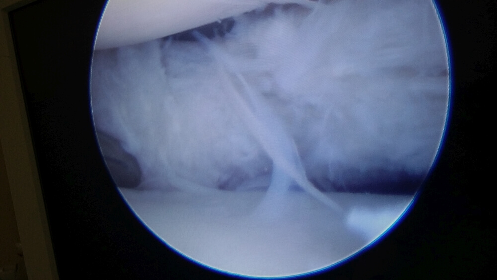 dis lateral meniskus yirtigi 6